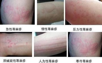 麻疹和荨麻疹哪些不同症状