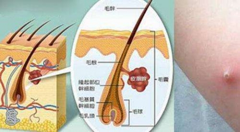 毛囊炎有哪些预防措施