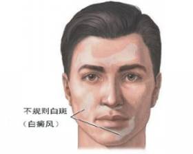 白癜风特点：不规则白斑