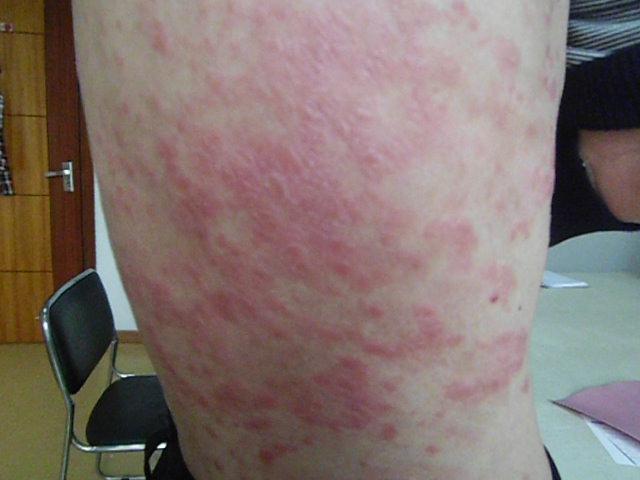 患者症状